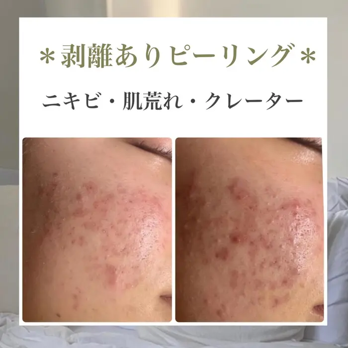 韓国肌管理室 ピーリング専門店 1521 韓国肌管理室 所属 韓国ピー リング専門店のエステ リラクカタログ ミニモ