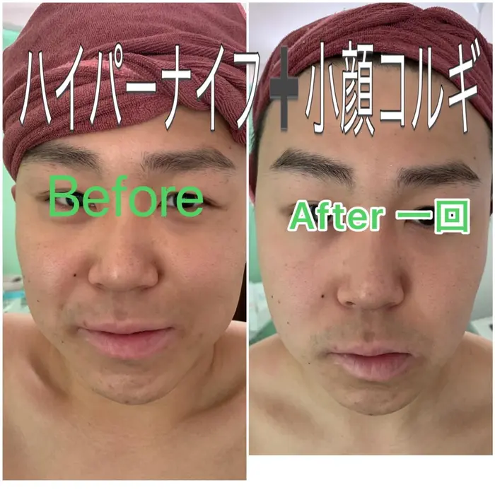 一回のビフォーアフターです ハイパーナイフ痩身 小顔コルギ ハーブピーリング K Beauty 東新宿所属 さいとう かずみのエステ リラクカタログ ミニモ