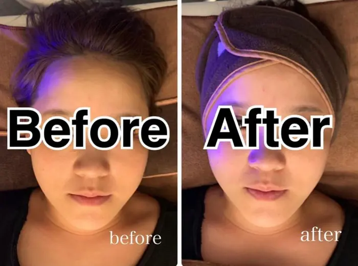 小顔ショット当て放題 脱毛 ハイフ Remore 渋谷所属 Remore 代表 土谷のエステ リラクカタログ ミニモ