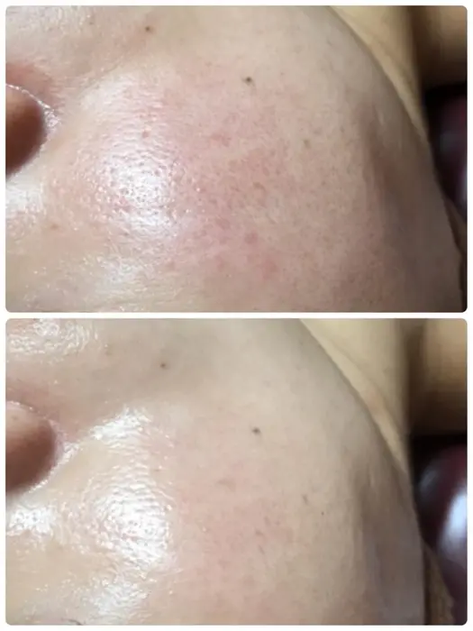 初陶肌トリートメント 毛穴の変化 赤みに注目 お肌の水分量アップし 若返りました ハーブ専門dioneさいたま店所属 佐藤 えみのエステ リラクカタログ ミニモ