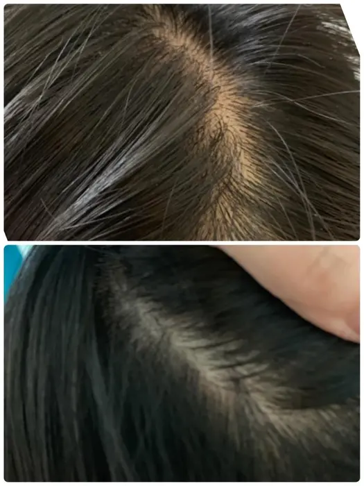 ヘッドスパ後は 頭皮の色も透明感が出ます カラダの質研究所rin所属 Kimico丸ごと ボディメンテナンスの エステ リラクカタログ ミニモ