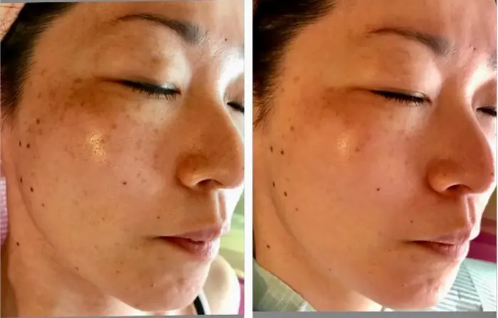 少しづつ でも確実に シミが薄くなるだけでも印象がかわりますね 美顔 整顔 Little My所属 美顔 整顔 Little Myのエステ リラクカタログ ミニモ