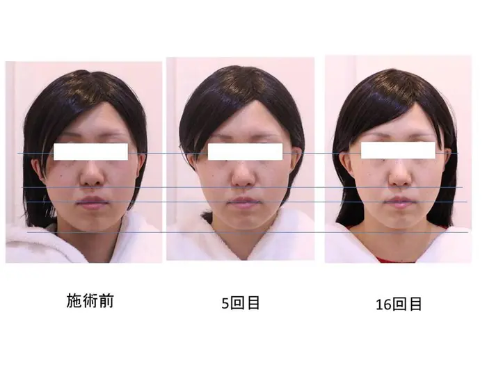 お顔の印象が変わるだけで ヘアメイクなども楽しくなります 名古屋栄店 美coul所属 小顔 メンズ小顔 バスト 浜野未来のヘアカタログ ミニモ