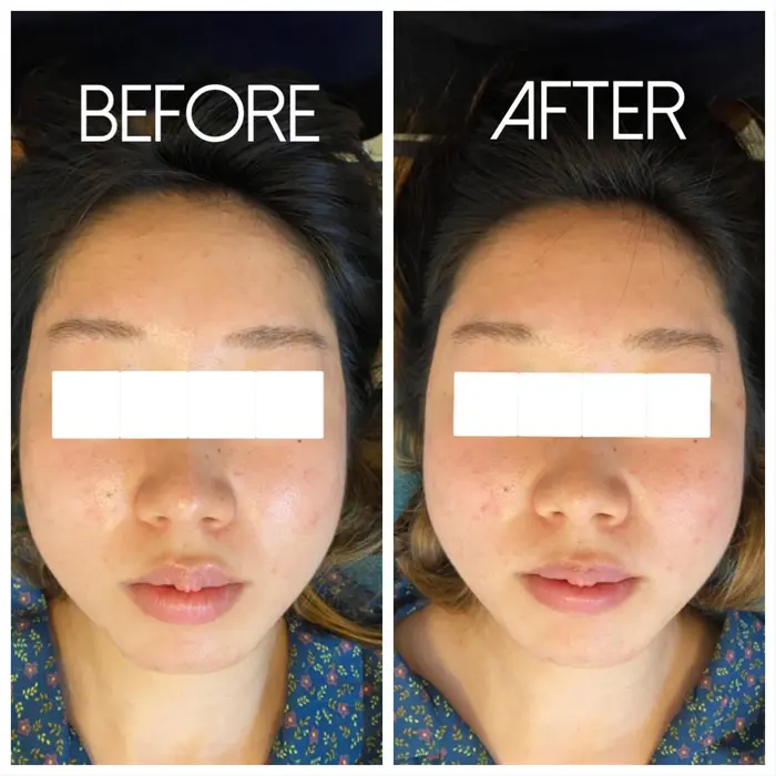 むくみが取れてすっきりです お顔が一回り小さくなりました メディカルカイロcoco所属 山口 聖実のエステ リラクカタログ ミニモ