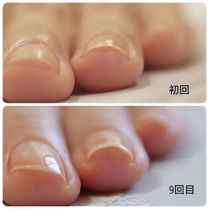 30代ダンサー 最強のネイルケアコース9回目 施術時間約60分 爪にカーブと厚みが出来てきたため 割 つぼみネイル所属 大阪市ネイルサロン つぼみネイル のネイルデザイン ミニモ