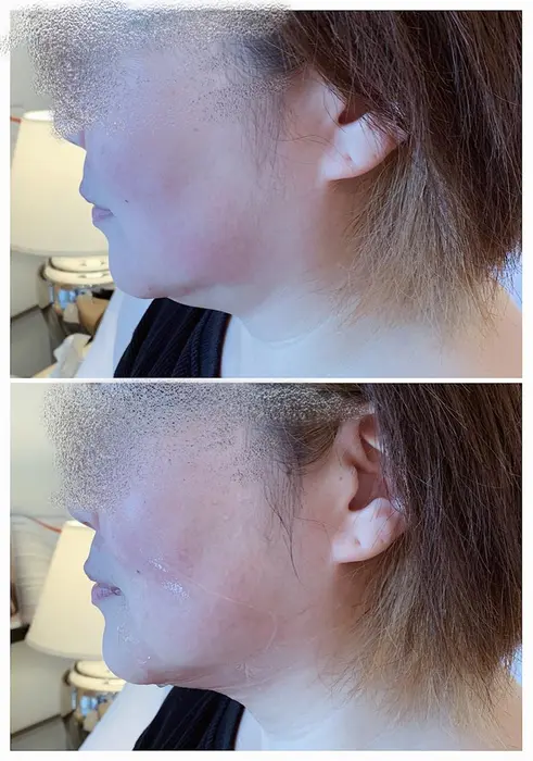 １度の施術でこの効果 二重顎に注目です 老廃物を流してあげることで二重顎の解消へと繋がりま 掛川自宅ネイルサロン所属 Tsuchi Yaのネイルデザイン ミニモ