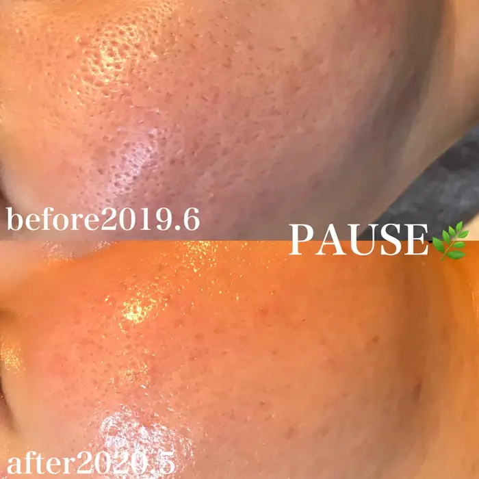 リアボーテ 肌再生エステ ご来店より約1年 ゴワゴワ 硬くなっていたお肌 アロマ エステ Pause ポーズ 所属 浜野 恵美のエステ リラクカタログ ミニモ