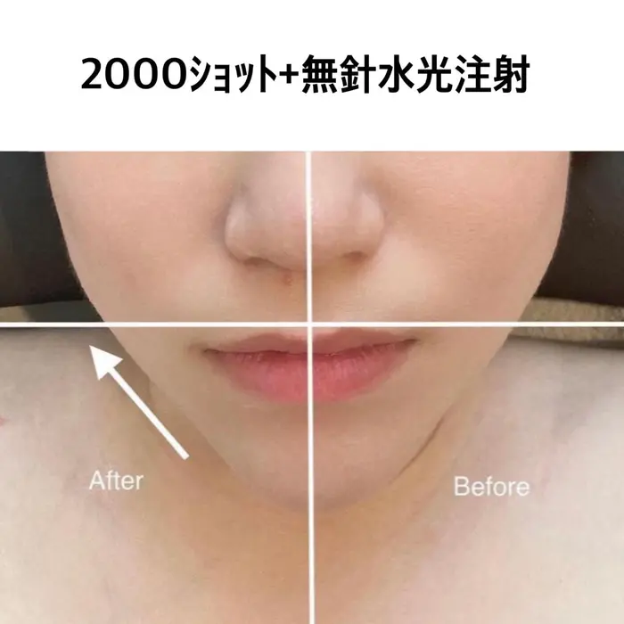 エステ版　水光注射　人肝細胞導入期 hq720.jpg?sqp=-