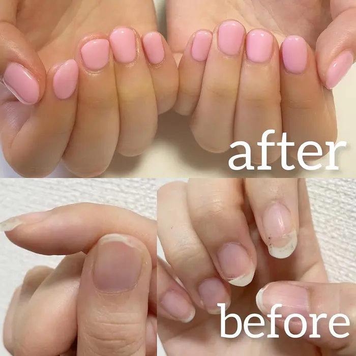 日常生活に支障をきたす爪に悩むお客様割れた爪は補強をしてジェルネイルで強度も出しました爪を傷つけ Yoshinonail所属 女装ネイリスト よしのの ネイルデザイン ミニモ