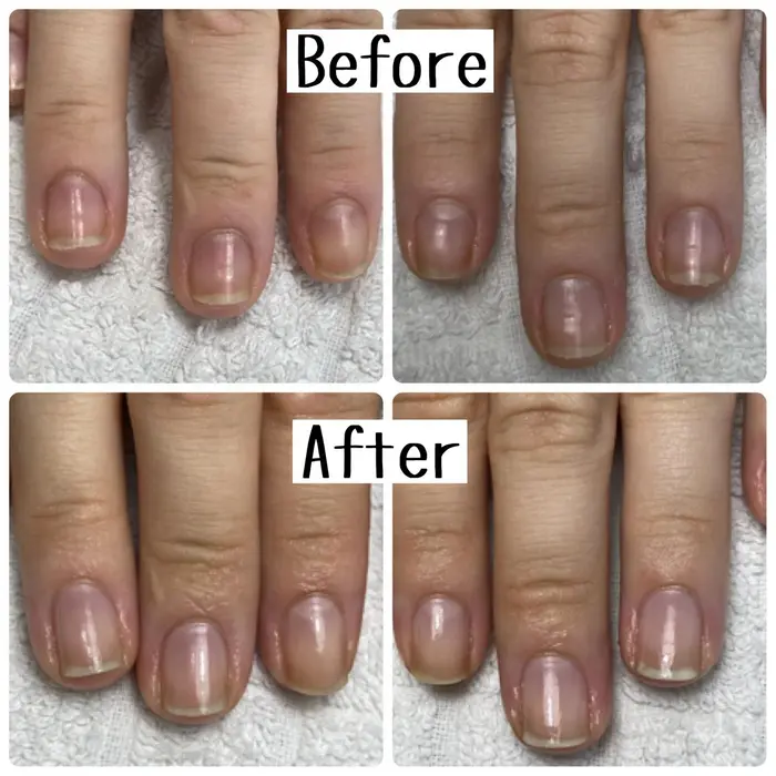 3ヶ月で地爪を縦爪にする最強のネイルケアコース 施術期間3ヶ月 施術時間１時間 代 調理師 Nail Salon Citrine所属 一森 李奈のネイルデザイン ミニモ