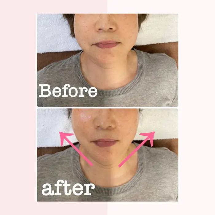 Hifu 一回の施術でこんなにもリフトアップが出来ました 糸リフトで小顔を目指していたのです 心身堂鍼灸整骨院 泉ヶ丘院所属 河合 一由 のエステ リラクカタログ ミニモ