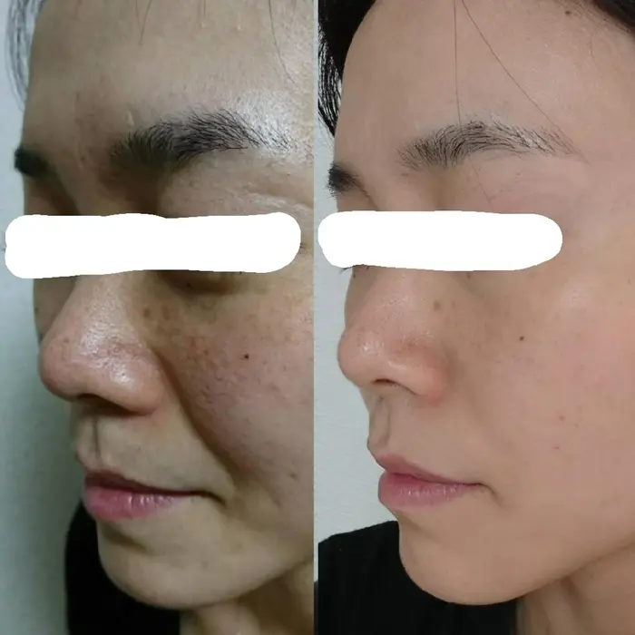 美肌改善しませんか シミ たるみ 肌荒れ ニキビ 赤ら顔 ひとつひとつ原因をさぐり改善いたしました Plein De Bonheurs所属 プラン ドゥ ボヌールのエステ リラクカタログ ミニモ