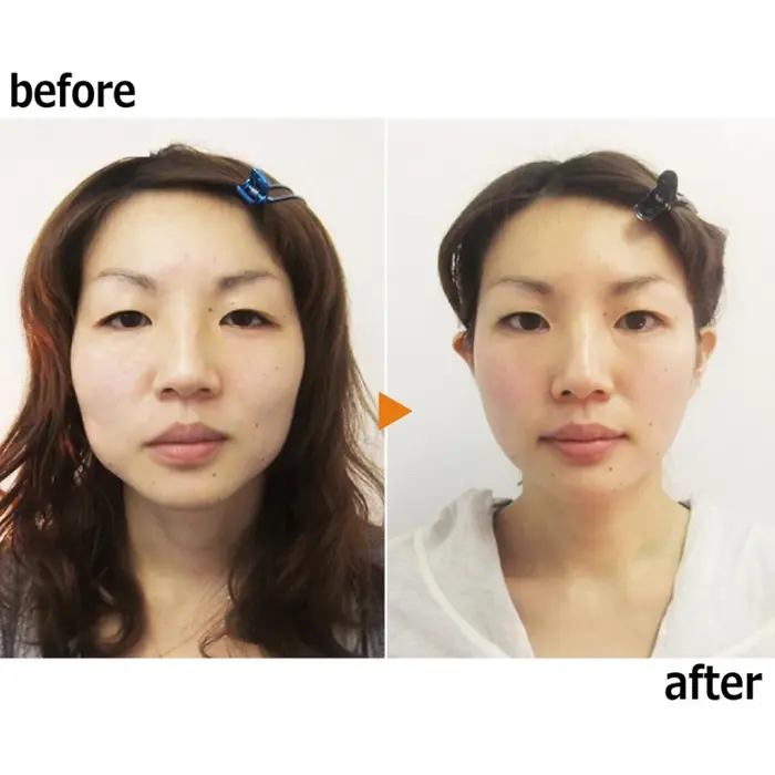 施術例 頬骨 エラ張り 目を大きく 美 Design 渋谷店所属 美 Design 渋谷店のエステ リラクカタログ ミニモ