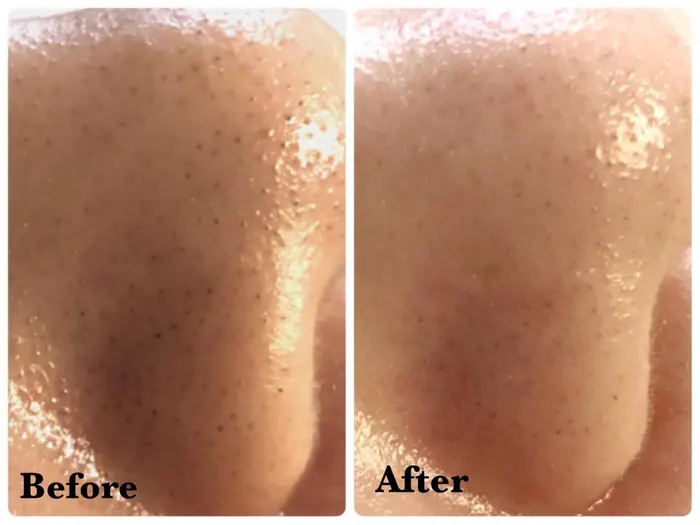 ハイドラフェイシャル 一回の効果です Laguna所属 Laguna ラグナ のエステ リラクカタログ ミニモ