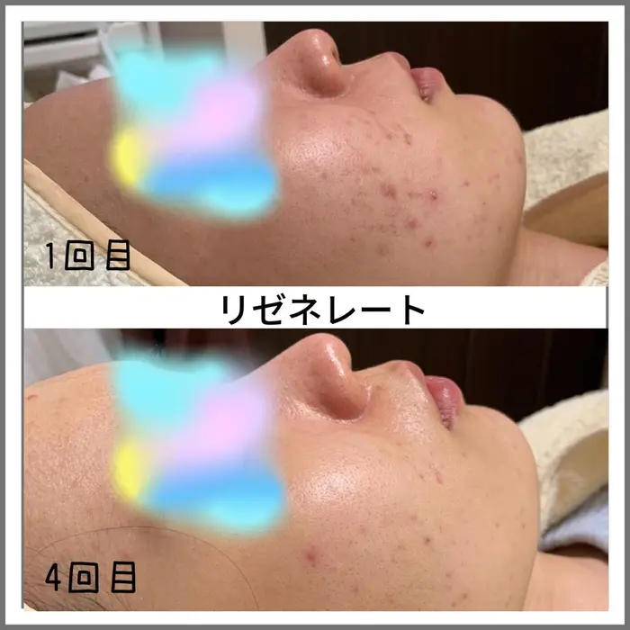 リゼネレート対応★チップ10個 京セラ KYOCERA】京セラ CCGT040101L-F TN60 旋削用チップ