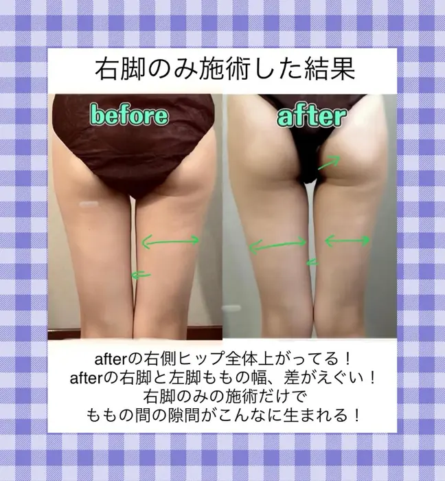 キャビテーション ラジオ波で理想の体型に導きます エスペロンス所属 エスペロンス痩身小顔 Sachiのネイルデザイン ミニモ キャビテーション ラジオ波で理想の体型に導きます エスペロンス所属 エスペロンス痩身小顔 Sachiのネイルデザイン ミニモ