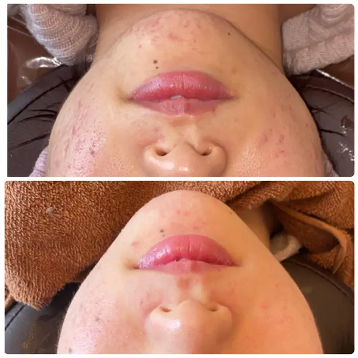 お顔リフトアップでスッキリ ニキビ改善はハーブピーリング Fleur所属 Fleur福岡店 Narumiのエステ リラクカタログ ミニモ