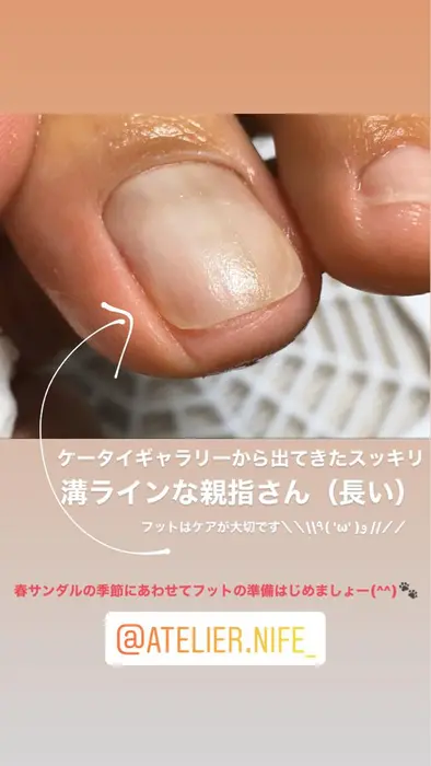 爪周りの角質ケアでしっかりお掃除した後 巻いている部分をカットしました 刺さりの跡地がくっきり Atelier Nife 所属 Atelier Nife のネイルデザイン ミニモ