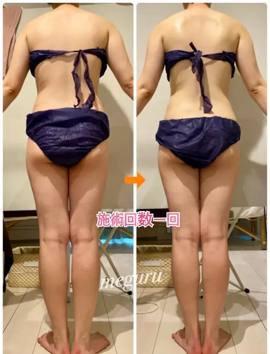 本日のbefore After 太ももやおしりは 脂肪が溜まりやすい場所です リ Meguru所属 痩身専門エステ 結果出し丹野のエステ リラクカタログ ミニモ