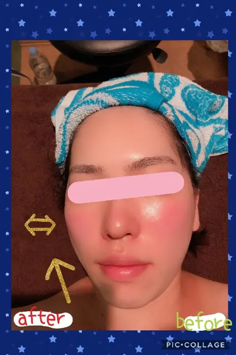 頬が細くなり リフトアップしているのがお分かりいただけると思います Seika House所属 Seika Houseのエステ リラクカタログ ミニモ