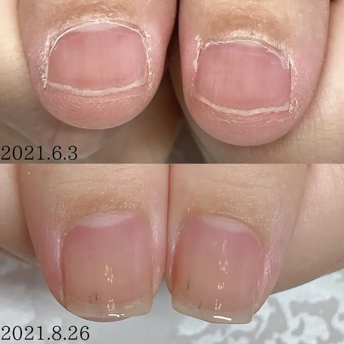 小さい爪 平らな爪 丸い爪 貝爪 男爪 反り爪などなど 爪のお悩みございませんか 3ヶ月全8回で美爪 Nail Salon Mimi所属 Nailsalon Mimiのネイルデザイン ミニモ