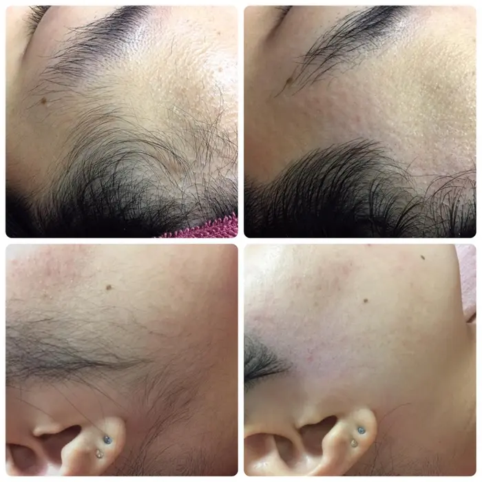 顔周りの毛が生えていると より一層くすんで見え肌の印象がかなり変わります 額やもみあげなど顔周りを ナチュラルリアンジェ所属 ナチュラル リアンジェのエステ リラクカタログ ミニモ