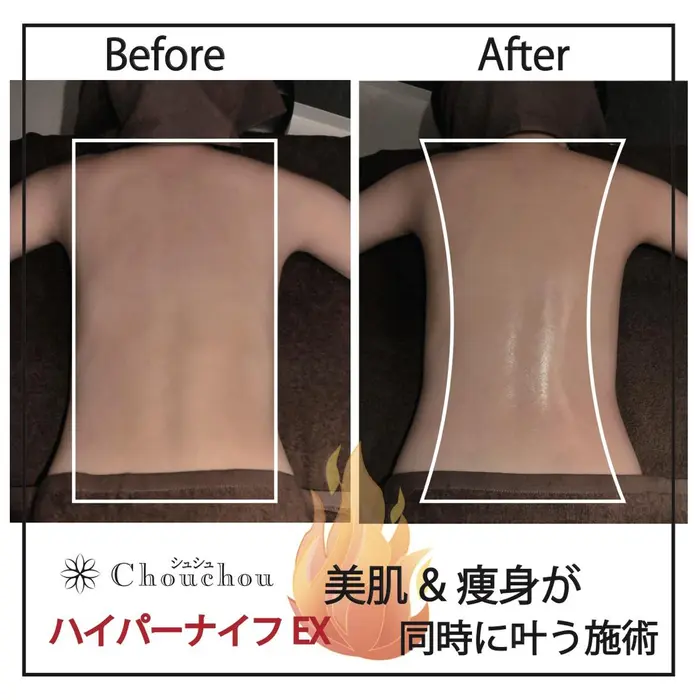 当店は 最上位機種ハイパーナイフex正規取扱店です 温め と ほぐし の同時施術で気にな Chouchou シュシュ 恵比寿所属 Chouchou 恵比寿のエステ リラクカタログ ミニモ