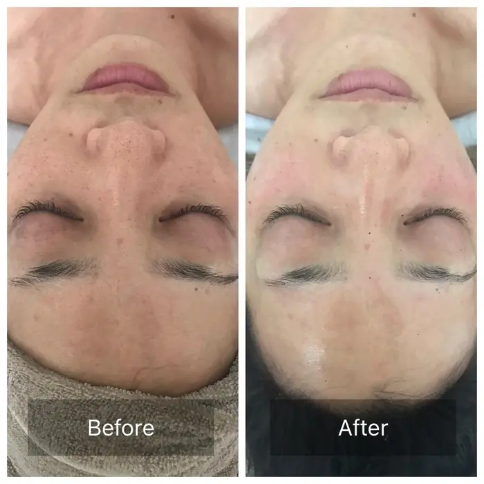 陶肌トリートメント1回目ビフォーアフター 艶感と肌のトーンアップがすごいです 毛穴の汚れ ごわつき Natu Lino所属 中島 未貴のエステ リラクカタログ ミニモ