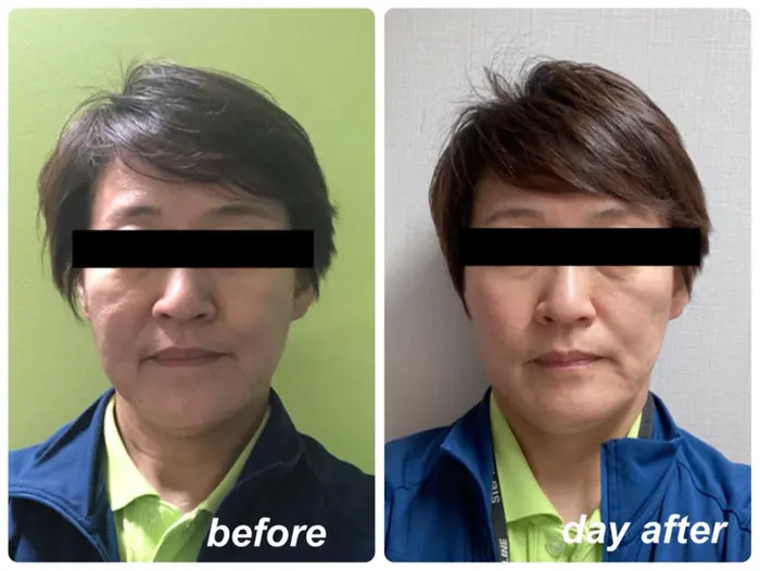次の日の方がよりお顔小さくなるため 皆様に次の日のお写真いただいてます 1回の施術です みんなのハイフ所属 大籔 はるかのエステ リラクカタログ ミニモ