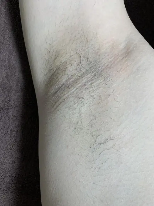 男性ワキ脱毛2回目終了 2ヶ月以上剃っていなくてこの薄さです 脇はとくに 効果を感じてるお 脱毛サロンqlat所属 脱毛サロン Qlatのエステ リラクカタログ ミニモ