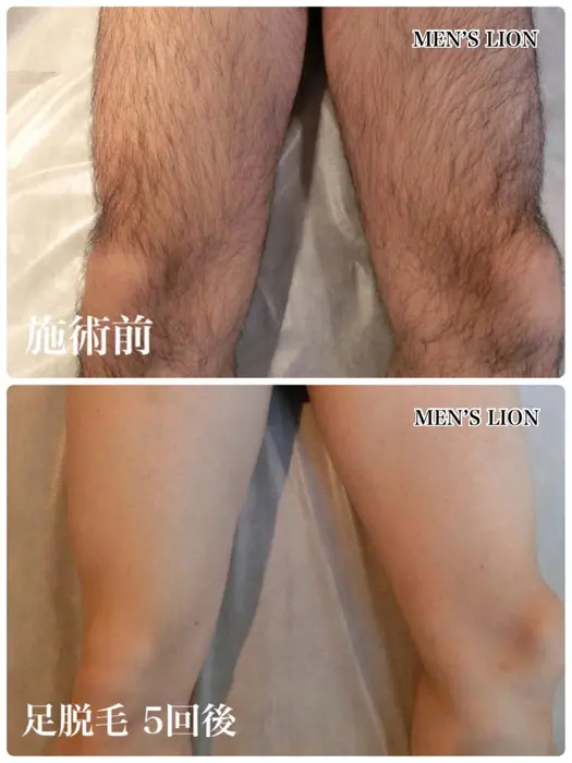 メンズ脱毛サロン Lion 渋谷店所属 メンズ脱毛 Lion 渋谷店のエステ リラクカタログ ミニモ