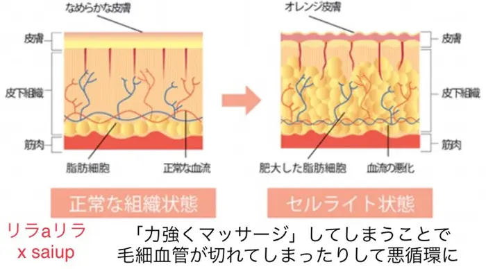 鋭く 貼り直す 活性化する 皮下 脂肪 セルライト Tousen Bo Jp