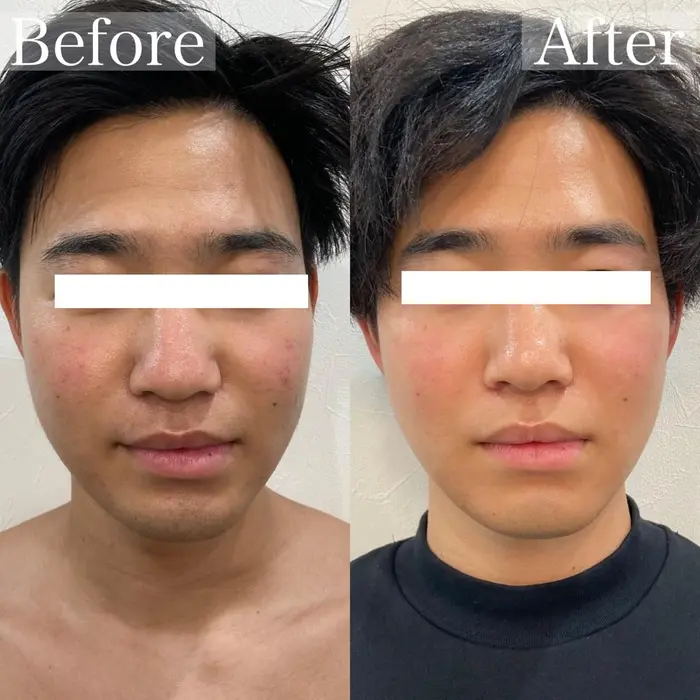 メンズ顔脱毛と光フェイシャル 8回目のビフォーアフター Salon De Che Ri所属 Salon De Che Ri梅田中津のエステ リラクカタログ ミニモ
