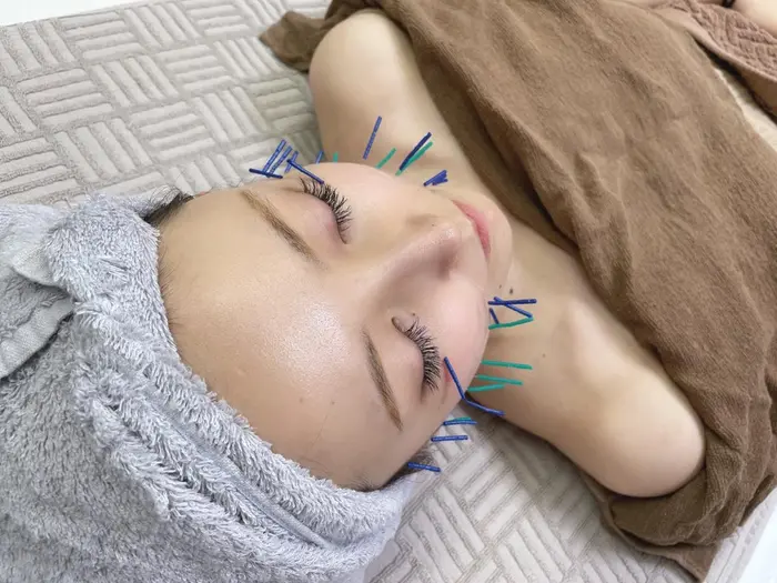 当院自慢の美容鍼エステの施術を受けていただいてるご様子です 6月のから日差しは強くなります シミ シ ヒフミ鍼灸院所属 山崎 恵美 のエステ リラクカタログ ミニモ