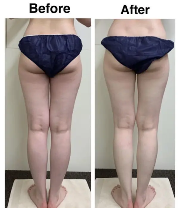 なかなか痩せない むくみが取れにくい下半身も代謝が上がり痩せ体質に エステティックrayvis梅田所属 Rayvis梅田 Aのエステ リラクカタログ ミニモ