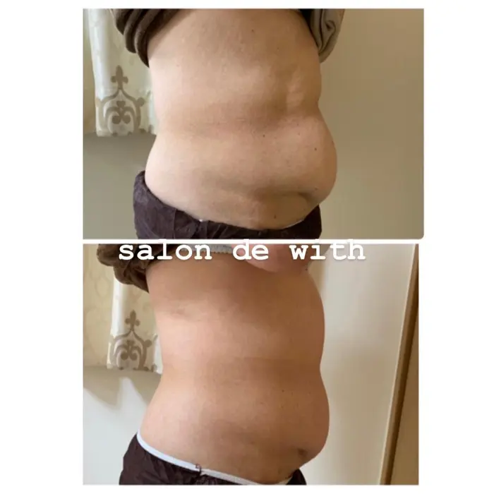 ５０代の方 お腹お手入れ比較写真です サロンドウィズ所属 清水 まなみのエステ リラクカタログ ミニモ