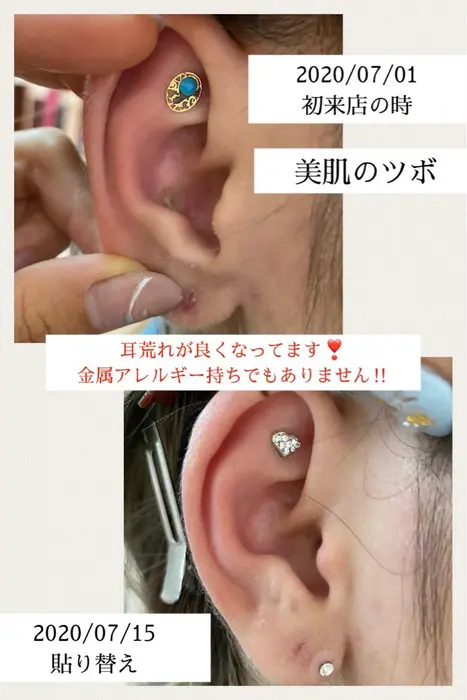 美肌のツボ 金属アレルギー持ちでもないのに 耳荒れがすごいお客様 肌荒れも酷かったのに ２週間後 Setsalon Churaku所属 浜比嘉 綾のヘアカタログ ミニモ