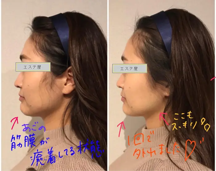 顎の梅干しジワ改善 エステ屋 ハイフ所属 月額制 ハイフ専門店 エステ屋のエステ リラクカタログ ミニモ