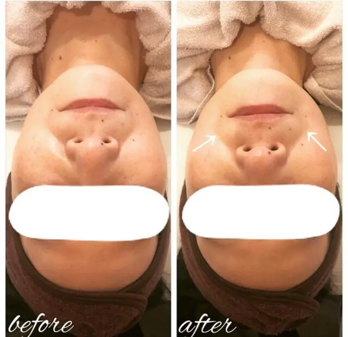 フェイシャルハイフのお客様 ほうれい線と首のシワにお悩みとのこと 頬と首を重点的に施術しました Karibu Hair Relax所属 Karibu Hair Relaxのエステ リラクカタログ ミニモ