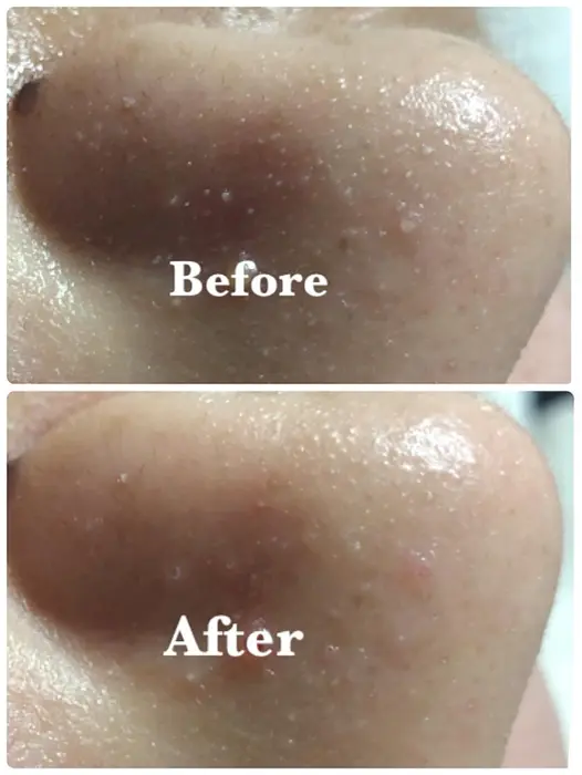 ハイドラフェイシャル 一回の効果です Laguna所属 Laguna ラグナ のエステ リラクカタログ ミニモ