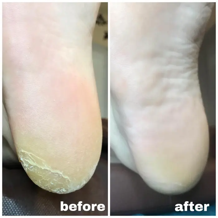 施術例 硬くなった踵もスッキリ Foot Fun フットファン 所属 Enomoto Yukoのヘアカタログ ミニモ
