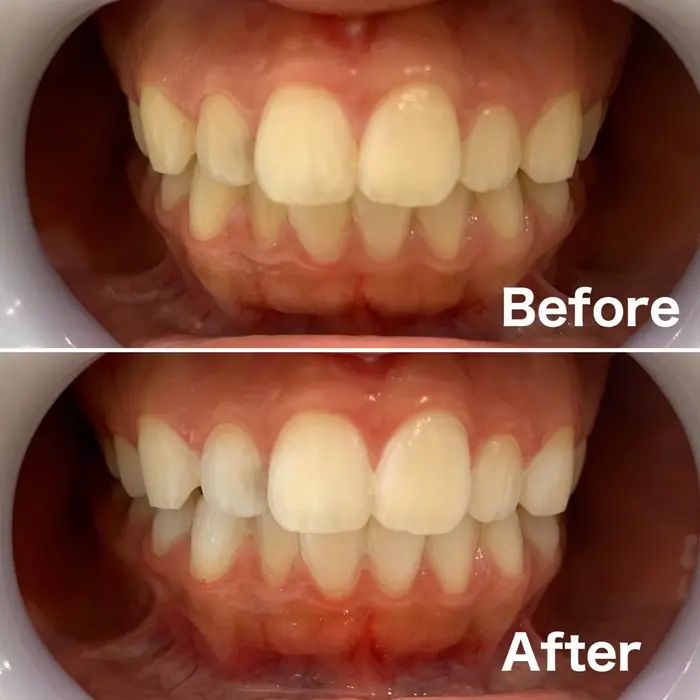 セルフホワイトニング8分 2回照射のビフォーアフターです 一度でこの白さになりました ポリリ ミュゼホワイトニングセルフ Beauty Boutique 東京駅前店所属 ミュゼホワイトニング セルフ 東京駅前店のヘアカタログ ミニモ