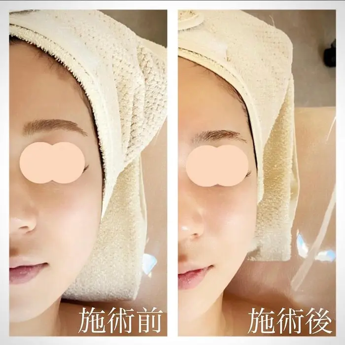 コルギ ハイフ 石膏パック 施術直後のお客様です コルギは施術後よりも2 3日後の方がス Re Bella Facial Herb所属 Re Bella 三浦のエステ リラクカタログ ミニモ