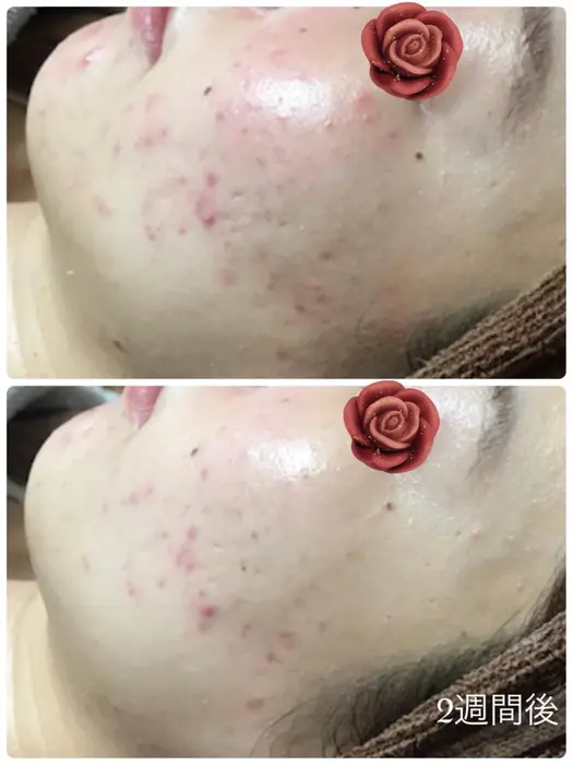 花粉とマスクで荒れてしまったお客様 2週間後 頬の赤みが引けていました ニキビも小さくなり治って ハーブ専門dioneさいたま店所属 佐藤 えみのエステ リラクカタログ ミニモ
