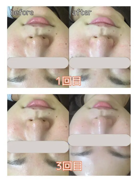 ハイドラフェイシャル効果 ビューティースタイリング自由が丘店所属 関口 仁美のエステ リラクカタログ ミニモ