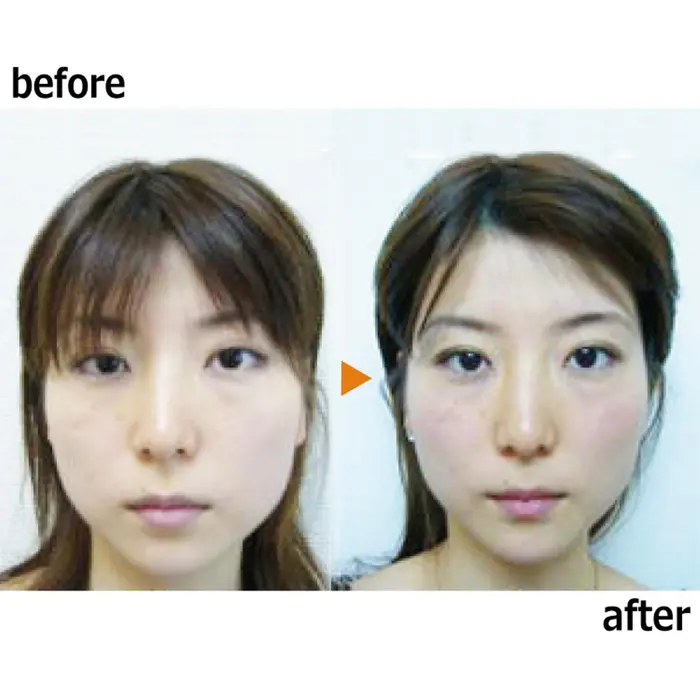 施術例 左右シンメトリー フェイスラインもスッキリ 銀座 美 Design 町田店所属 銀座美 Design 町田店のエステ リラクカタログ ミニモ