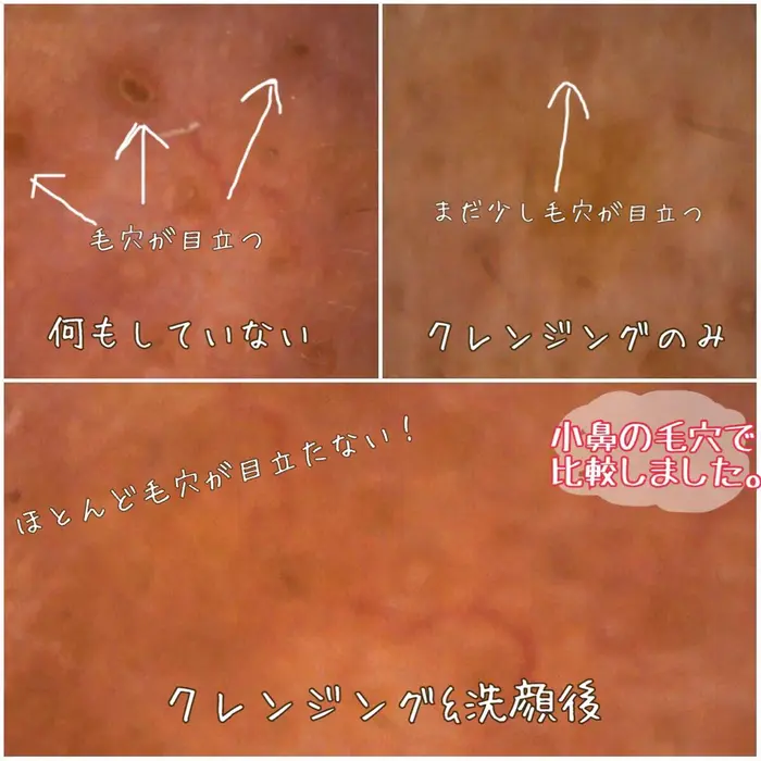 優しいタッチのクレンジングと洗顔で 毛穴の奥の汚れまでスッキリと洗い上げていきます このあとの毛穴 クラブビューティショップ大阪心斎橋店所属 クラブビューティ ショップ大阪心斎橋店のエステ リラクカタログ ミニモ