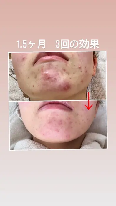 スキンプロサロン 大人ニキビ ニキビ跡 背中ニキビケア 所属 ハーブピーリング スキンプロサロンのエステ リラクカタログ ミニモ