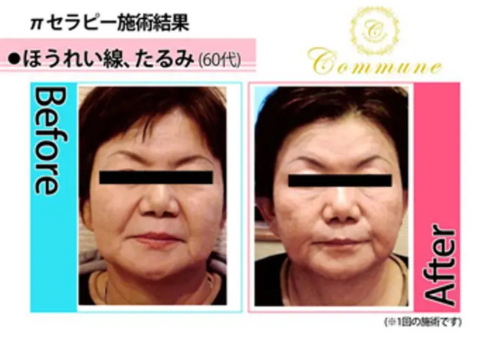 パイテラピー造顔フェイシャル 加齢による たるみ ほうれい線が気になる方 お肌にハリ 艶が欲しい方 Vert ヴェール 所属 卯月 のエステ リラクカタログ ミニモ