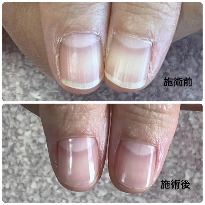 40代医師 最強のネイルケアお試し1回 施術時間約90分 施術効果には個人差があります つぼみネイル所属 大阪市ネイルサロン つぼみネイルのネイル デザイン ミニモ